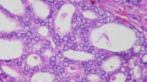 Cambios en una proteína impulsan metástasis en el cáncer de próstata