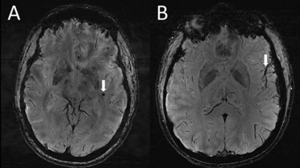 Las migrañas producen cambios en el cerebro