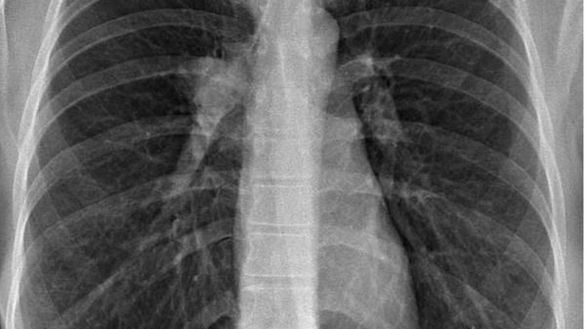 Científicos y pacientes cuestionan el rechazo a un fármaco para cáncer de pulmón