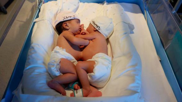 Separadas con éxito las bebés siamesas en el Hospital Sant Joan de Déu de Barcelona