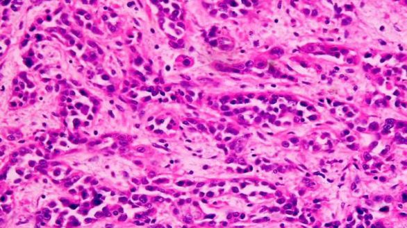 Análisis génico pionero para el cáncer gástrico difuso hereditario