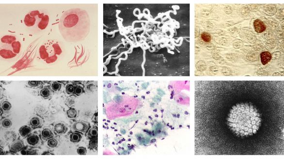 Las enfermedades de transmisión sexual se disparan en España