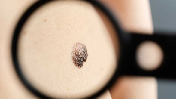 Melanoma: ¿cómo se produce la metástasis ósea?
