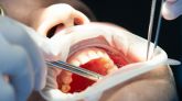 Eliminan con ultrasonidos células cancerosas de la boca