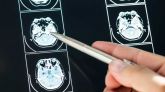 Una resonancia de cerebro para detectar la enfermedad de Alzheimer.