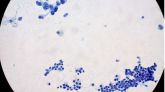 Páncreas: adenocarcinoma frente a epitelio ductal normal en FNA