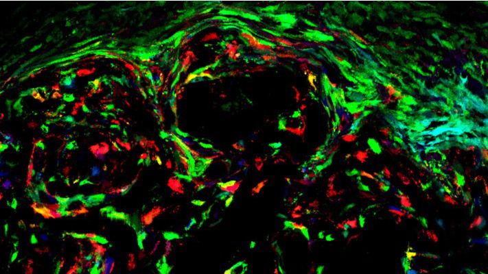 Tecnología multicolor para convertir un tumor en un 'lienzo'