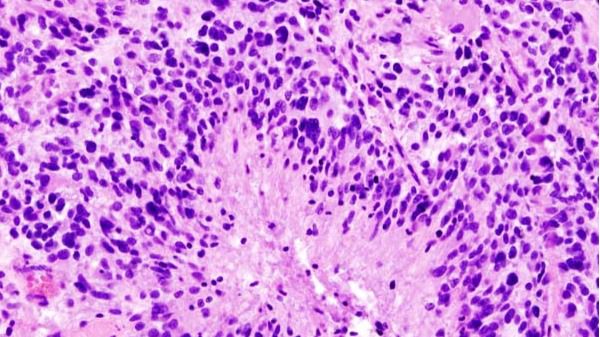 Crean nanopartículas capaces de penetrar en el tumor cerebral más común