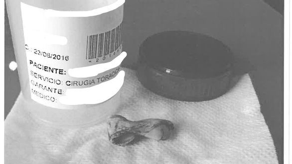 Indemnizada una mujer que tenía un trozo de cemento junto al corazón tras una cirugía