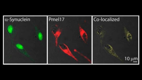 Encuentran un vínculo molecular entre el Parkinson y el melanoma