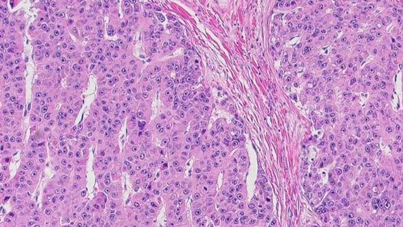 Avances para conseguir un fármaco contra un cáncer de hígado letal en niños y jóvenes