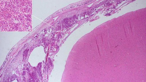 Descubren cómo algunas bacterias de la meningitis evaden el sistema inmune