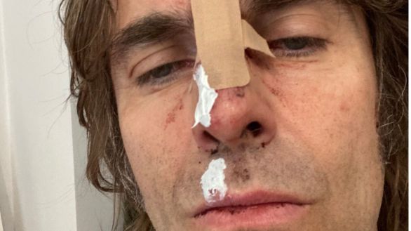 Liam Gallagher aparece herido en una foto tras caer de un helicóptero