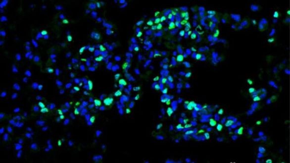 Descubren la capacidad de una clase de glóbulos blancos para combatir el cáncer