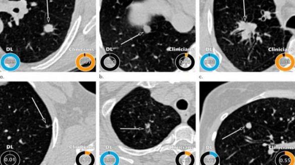 Detectan con Inteligencia Artificial el riesgo de padecer cáncer de pulmón