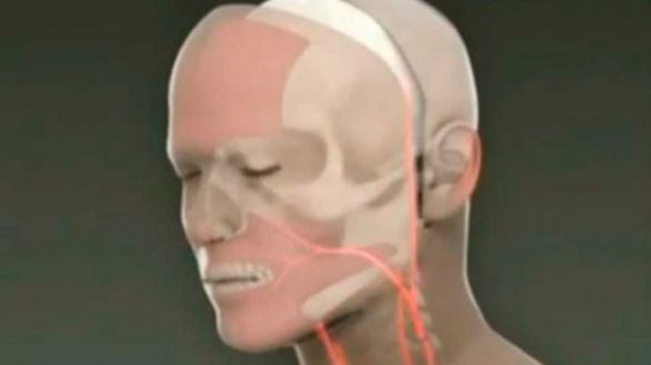 Avances en técnicas de trasplante facial