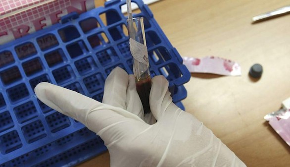 España arranca el primer ensayo clínico mundial para erradicar el VIH en pacientes oncohematológicos