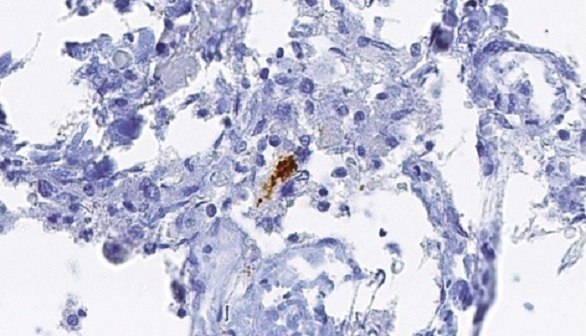 El alzhéimer es transmisible, según un estudio publicado por 'Nature'