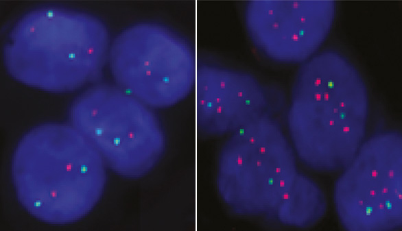 El gen responsable de la metástasis del cáncer de mama a huesos