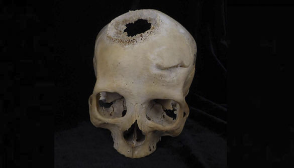 Hallan en Egipto pruebas de una cirugía oncológica de hace 4.500 años