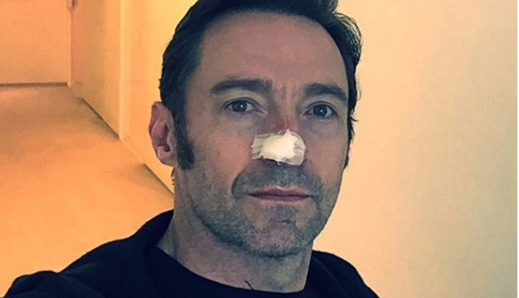 El actor Hugh Jackman, operado de nuevo de cáncer de piel
