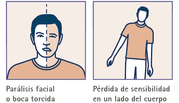 Identificar los síntomas del ictus, clave para minimizar las secuelas o salvar la vida