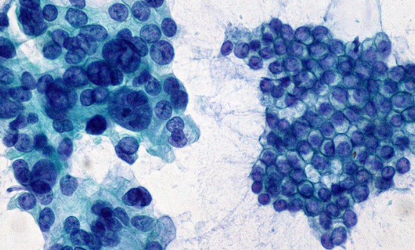 Descubierto un nuevo fármaco para el tratamiento del cáncer de páncreas
