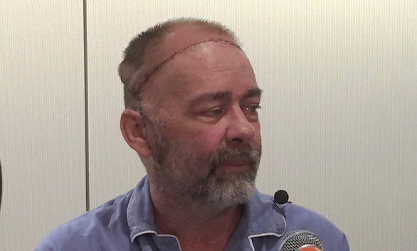 Un hombre recibe el primer trasplante de cráneo y cuero cabelludo