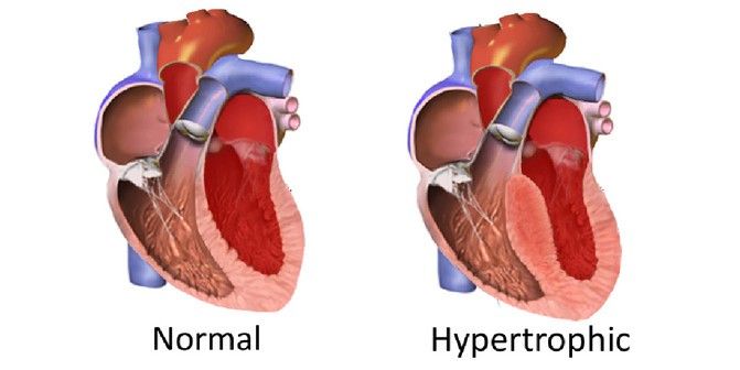 Diferencia entre un corazón normal y otro con hipertrófia. / IBS, South Korea