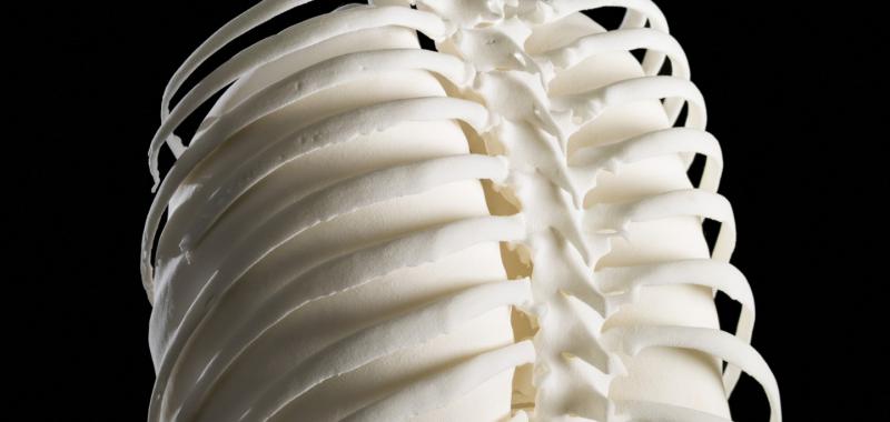 ILUSTRACIÓN EN 3D DE LOS PULMONES DE UNA MUJER DIAGNOSTICADA DE LINFOMA DE HODKING