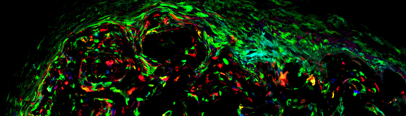 Modelo evolutivo de los osteosarcomas. La imagen muestra cada célula tumoral con un color diferente, evidenciando la historia evolutiva del tumor