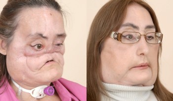Imagen facilitada por la Clínica Cleveland que muestra a la paciente Connie Culp antes de ser operada, (i), y tras someterse a la reconstrucción facial (Efe)